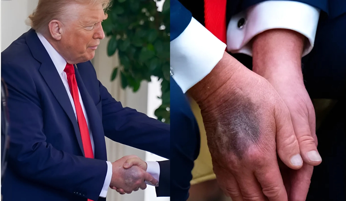 Donald Trump Bruised Hand