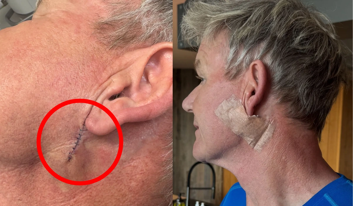 Gordon Ramsay Skin Cancer