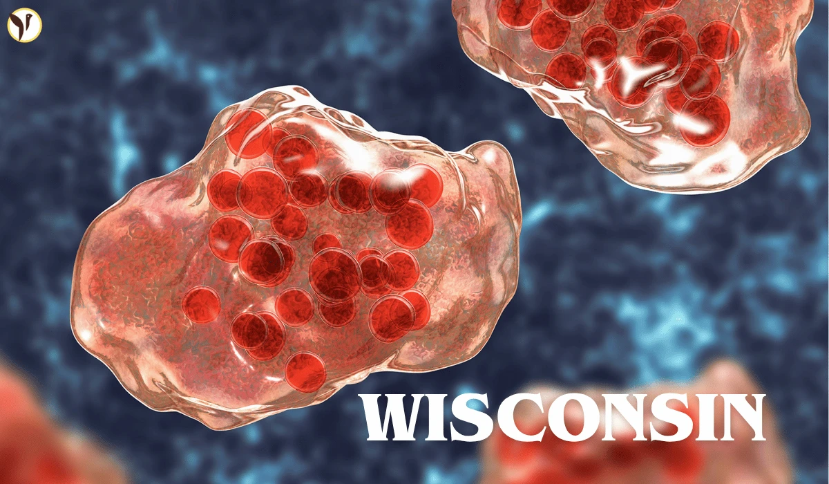Wisconsin Has Had 171 Measles Cases This Year: 170 of Them Were Unvaccinated.